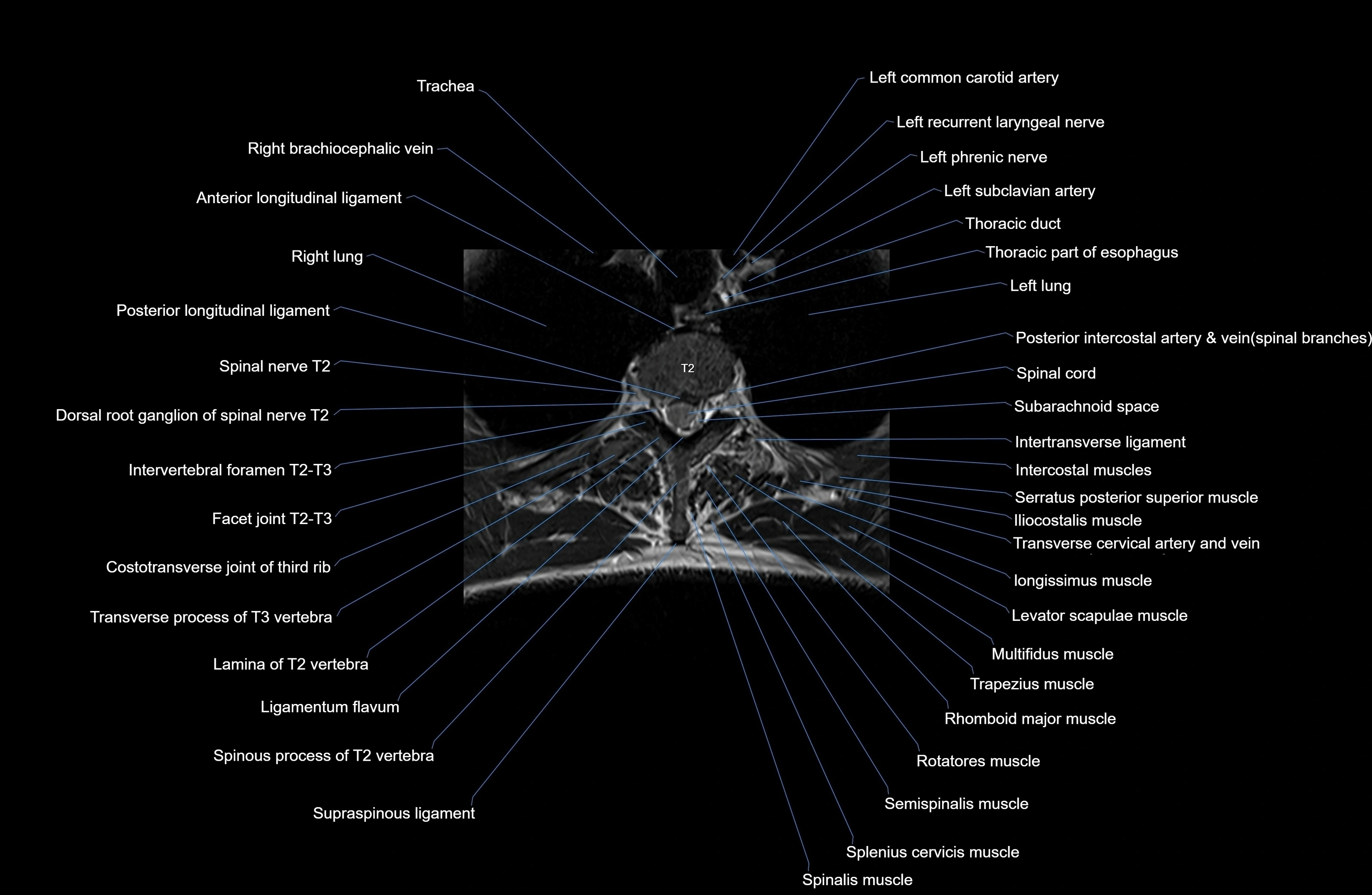 MRI thoracic spine axial  cross sectional anatomy 3T radiology  image-img-00001-00016.webp